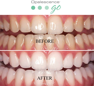 whitening photo15