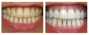 whitening photo16